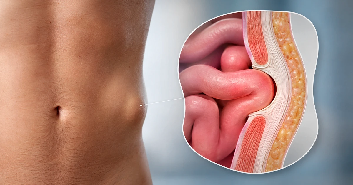 Ilustração de Cirurgia de Hérnias Abdominais